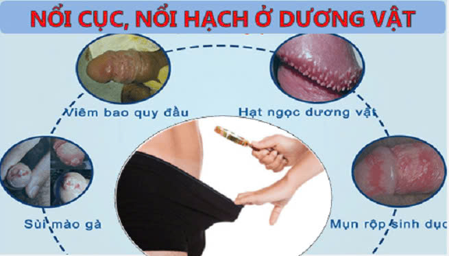 NỔI HẠCH BAO QUY ĐẦU: NGUYÊN NHÂN, DẤU HIỆU, VÀ CÁCH ĐIỀU TRỊ